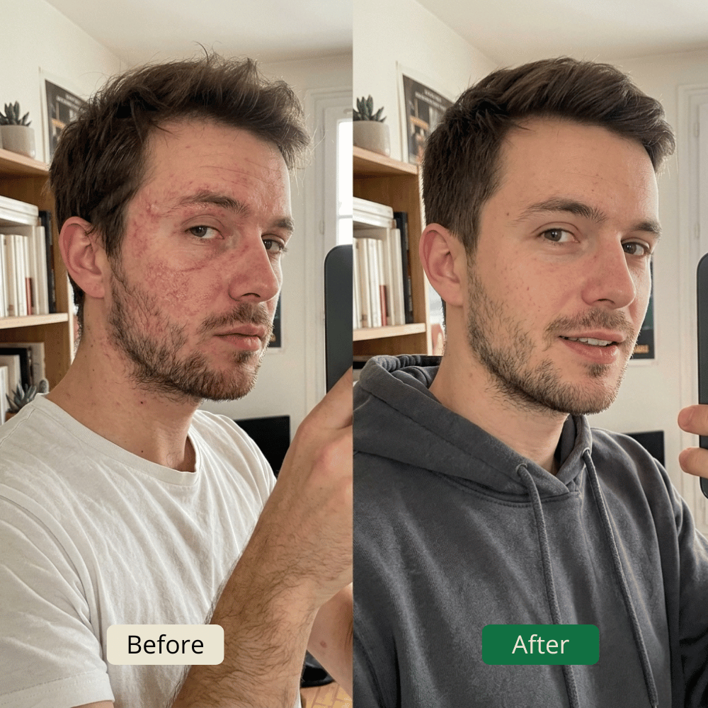 How to Get Rid of Eczema Naturally (Without Harsh Chemicals)